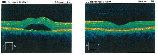 Optisk koherenstomografi av sykt og friskt øye. Et hulrom med væske kan ses mellom netthinnens lag. På det friske øyet ses et søkk der skarpsynet sitter