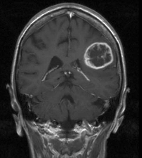 glioblastom who grad iv 1 glioblastom who grad iv 1
