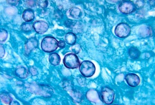 Histoplasma capsulatum. Fra Centers for Disease Control and Prevention.