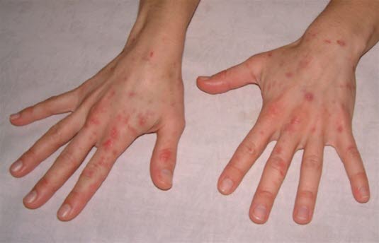 Typiske hudforandringer ved porfyria cutanea tarda på lyseksponert hud.