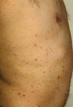 Typisk lokalisasjon av Malassezia follikulitt (tidligere benevnt Pityrosporum follikulitt eller pityriasis follikulitt). Akneliknende papler og pustler på øvre del av trunkus.