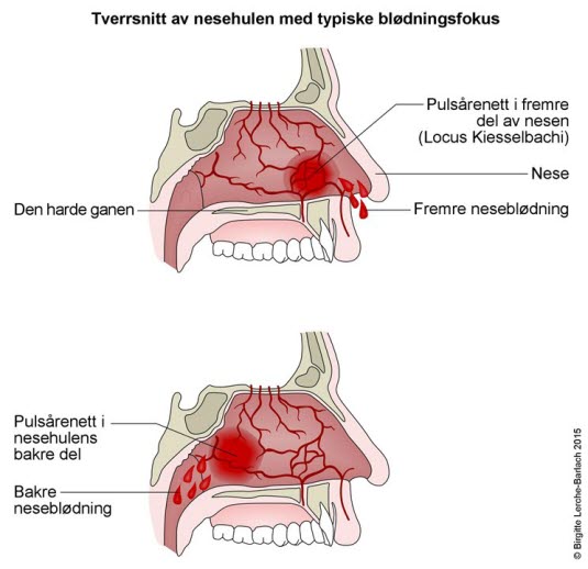 Neseblødning, fremre og bakre Neseblødning, fremre og bakre