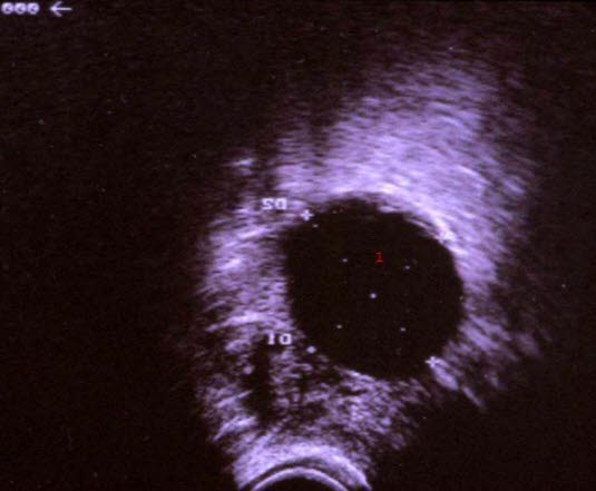 Enkamret, ekkofattig cyste