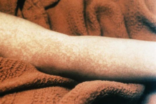 Fra US Centers for Disease Control and Prevention.