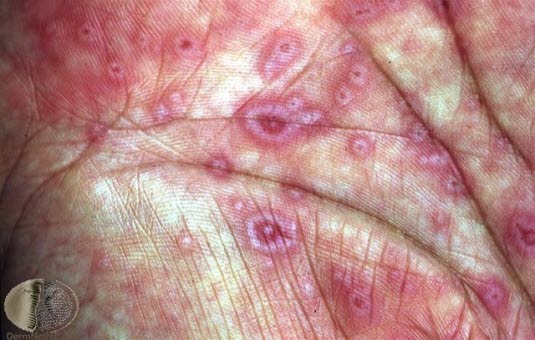 Erythema multiforme, håndflate