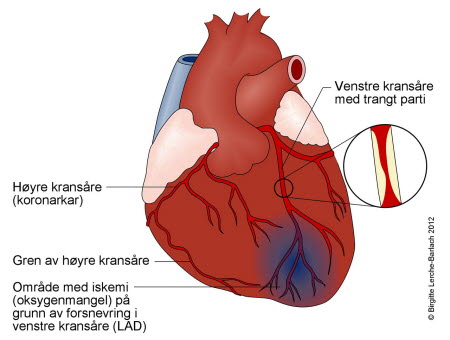 10647-2-hjerte-med-angina.jpg