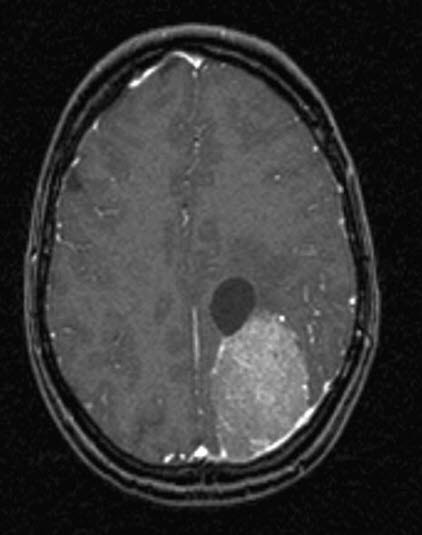meningiom med cyste 2 meningiom med cyste 2