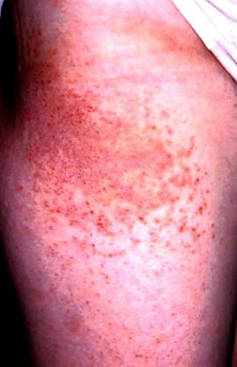 Kontaktallergisk eksem