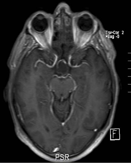 kraniopharyngeom 2 kraniopharyngeom 2