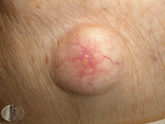 Epidermoid cyste lukket