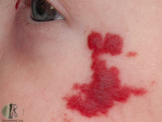 Hemangiom, proliferasjonsfasen 1