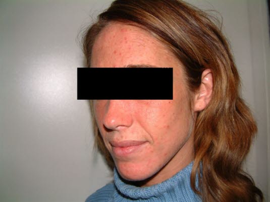 Typiske hudforandringer ved porfyria cutanea tarda på lyseksponert hud.