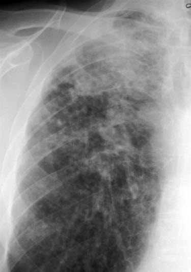 Silikose, røntgen Silikose, røntgen