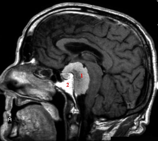 Meningiom (med kontrast)