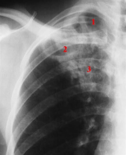 Lungetuberkulose Lungetuberkulose