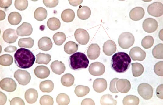 Kronisk lymfatisk leukemi (x 100)