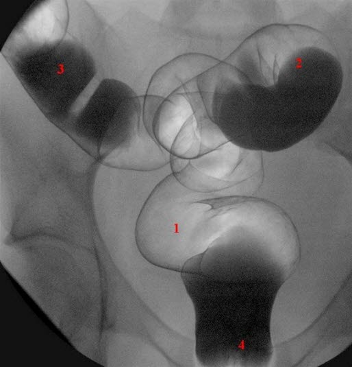 Colon oversikt rektosigmoideum Colon oversikt rektosigmoideum