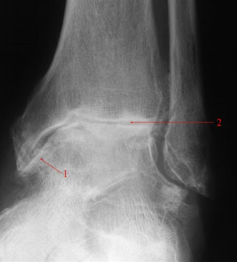 Ankelartrose, skrå front