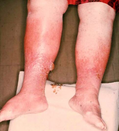 Svære ødemer og eksem med væsking.