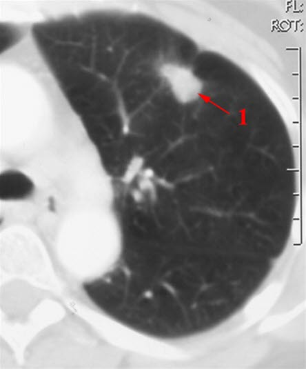 CT-bilde av lunge med svulst