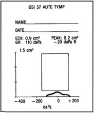 Tympanogram, mulig serøs otitt Tympanogram, mulig serøs otitt