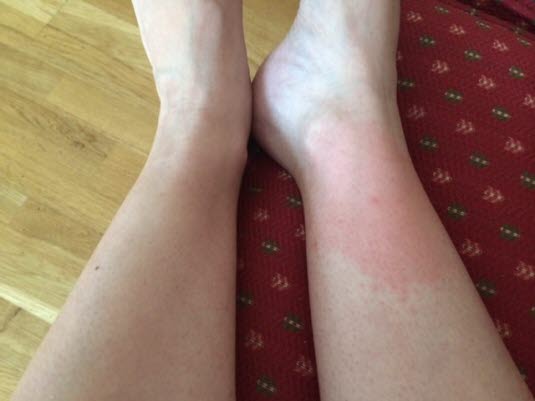 Gravid kvinne med erytema migrans på leggen. Utslettet kom 10 dager etter flåttbitt. Utslettet har en svak rødfarge og er ujevnt i kantene. Flåtten har sittet på den lille røde prikken i midten. Gjengitt med tillatelse fra Flåttsenteret Gravid kvinne med erytema migrans på leggen. Utslettet kom 10 dager etter flåttbitt. Utslettet har en svak rødfarge og er ujevnt i kantene. Flåtten har sittet på den lille røde prikken i midten. Gjengitt med tillatelse fra Flåttsenteret