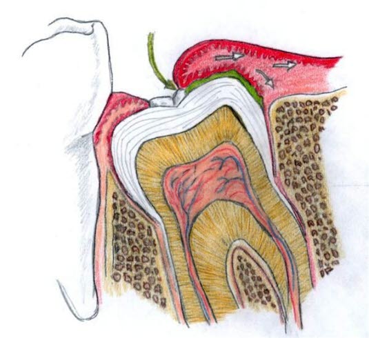 Illustrasjon av perikoronitt