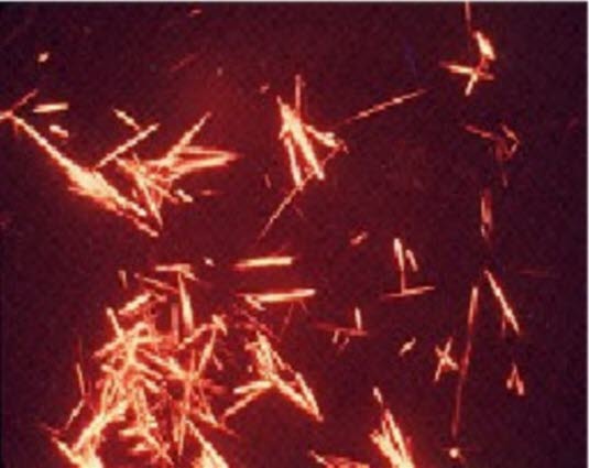 uratkrystaller uratkrystaller