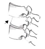 Spondylolistese Spondylolistese