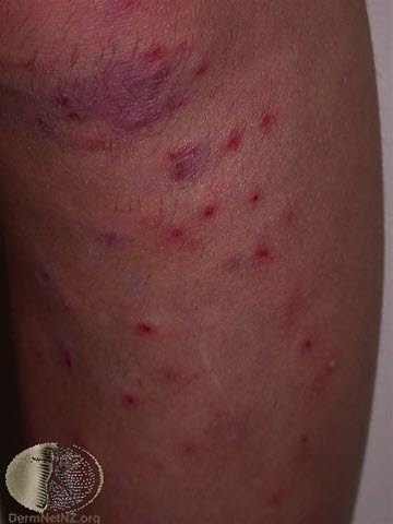 Follikkulitt, legger