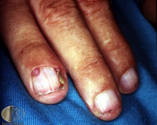 Tuberøs sklerose, periungalt fibrom