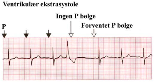 Ventrikulær ekstrasystole (B)