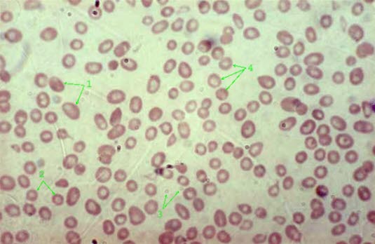 Makrocytær anemi (x 40)