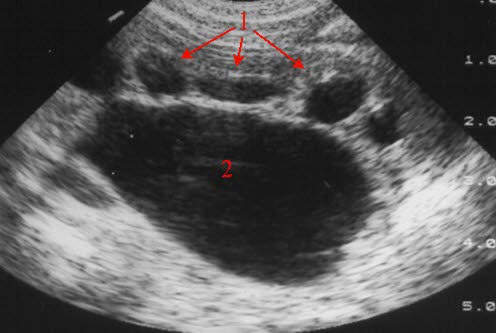 Overgangs-stenose (UL)