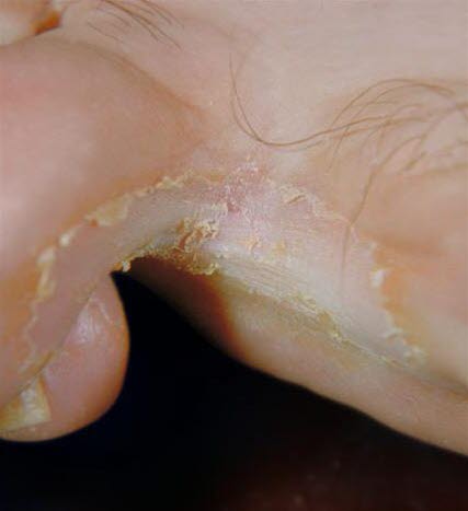 Fotsopp, interdigital