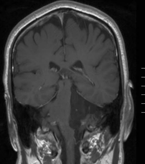 epidermoid tumor 1 epidermoid tumor 1