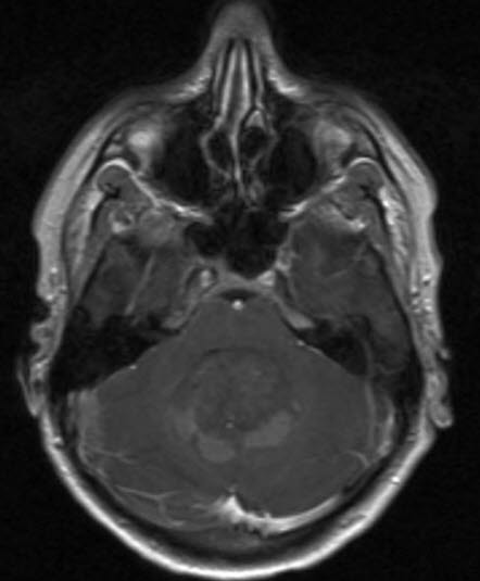 medulloblastom 1 medulloblastom 1