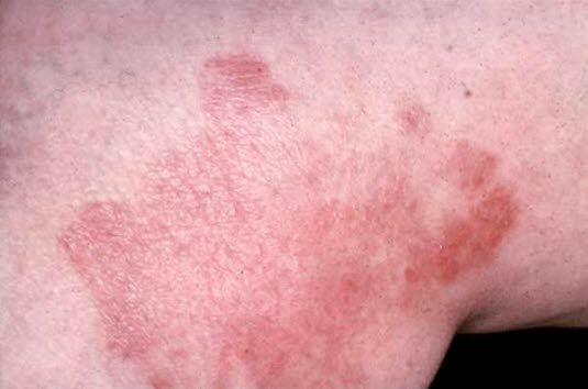 Neurodermitis chronica circumscripta.