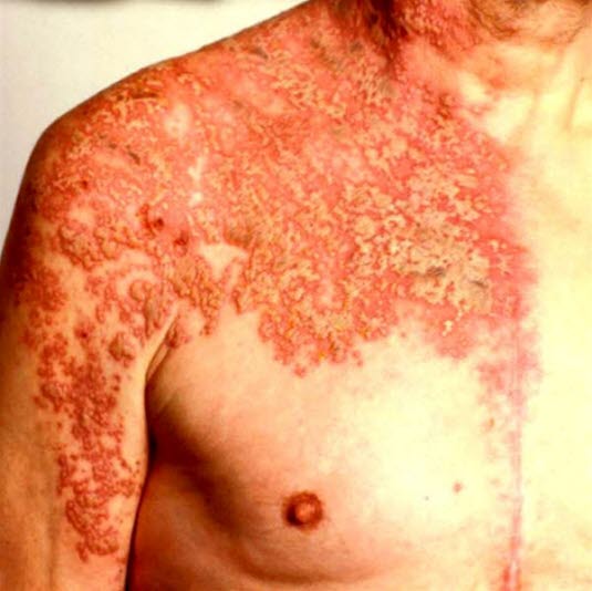 Herpes zoster gir grupperte vesikler på erythematøs bunn, som regel ikke å så alvorlig grad som på bildet. Utbredelse langs dermatom og halvsidig utbredelse er typisk, men ikke absolutt.