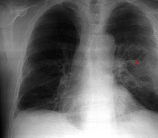 Lungeabscess - etter behandling