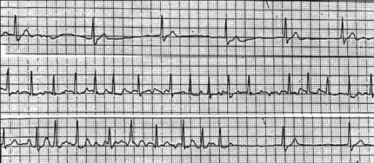 Syk-sinus-syndrom Syk-sinus-syndrom