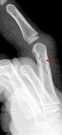 Phalanx-fraktur side