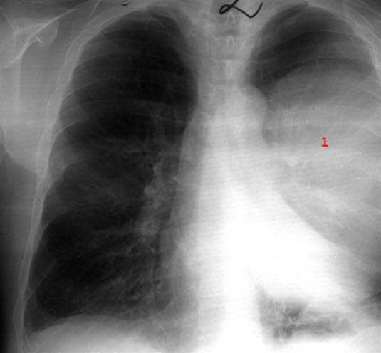 Lungeabscess - front