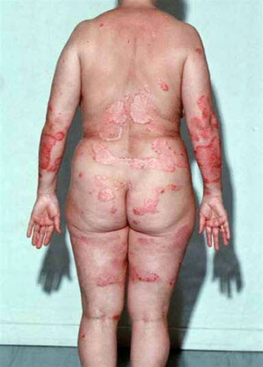 Psoriasis Psoriasis