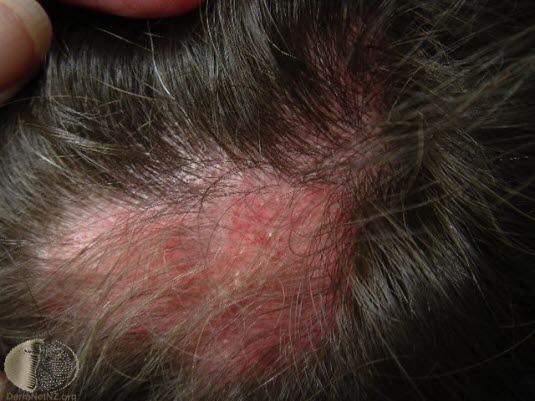 Diskoid lupus erythematosus, hodebunn