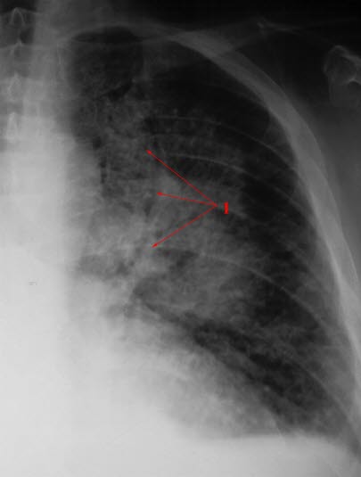 Hjertesvikt, alvorlig Hjertesvikt, alvorlig
