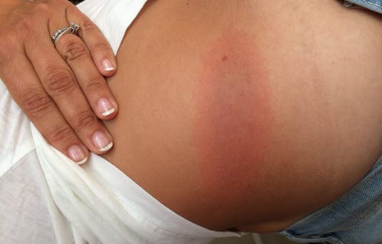 Erytema migrans på siden av magen. Utslettet kom tre uker etter flåttbitt og lignet først et vanlig blåmerke. Hvis man ser nye etter kan man se en tydelig ring. Gjengitt med tillatelse fra Flåttsenteret Erytema migrans på siden av magen. Utslettet kom tre uker etter flåttbitt og lignet først et vanlig blåmerke. Hvis man ser nye etter kan man se en tydelig ring. Gjengitt med tillatelse fra Flåttsenteret