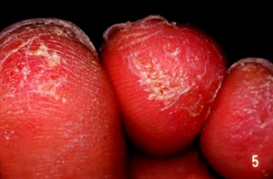 Discoid lupus erytematosus