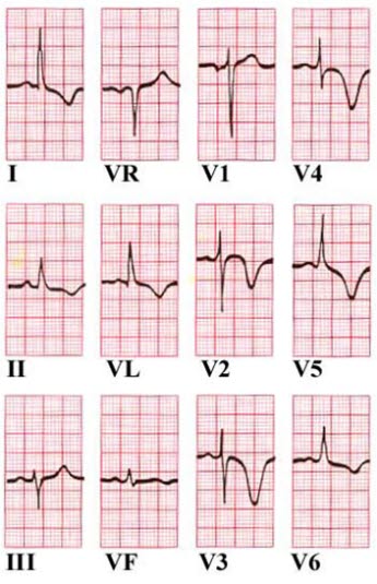 Ikke-Q-bølge infarkt Ikke-Q-bølge infarkt