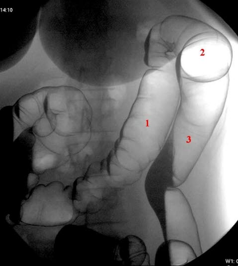 Colon, venstre flexur